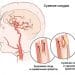 Сужение сосудов головного мозга - лечение